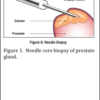 Needle Core biopsy if prostate gkabd