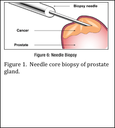 Needle Core biopsy if prostate gkabd