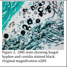 GMS Stain showing fungal hyohae