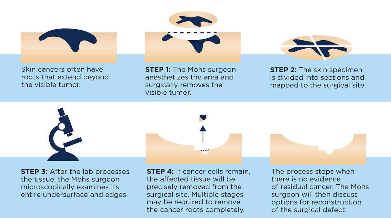 MOHS-Surgery-Puget-Sound-Dermatology
